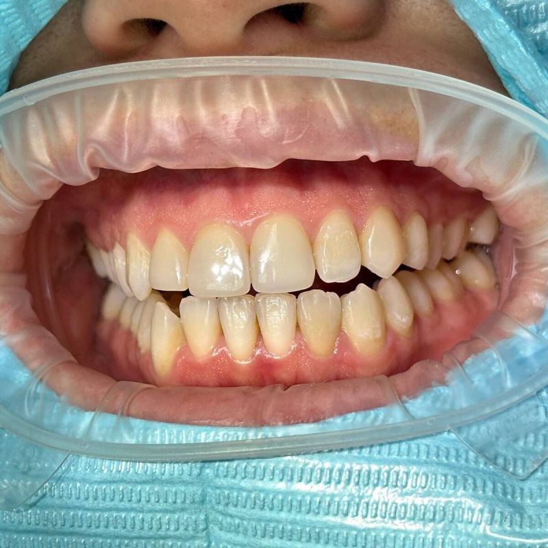 Профессиональная гигиена: Путь к здоровым и сияющим зубам