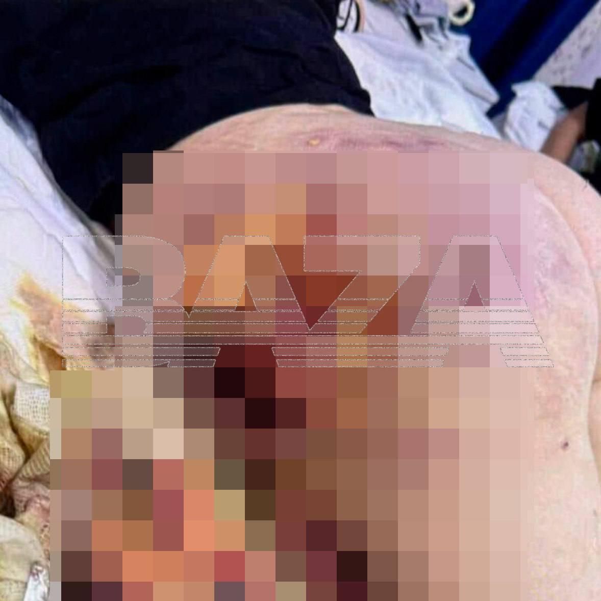 Десятки россиянок обвинили популярного косметолога в изуродованных телах после бьюти-процедур, называя её «мясником» Десятки россиянок обвинили популярного косметолога в изуродованных телах после бьюти-процедур, называя её «мясником»