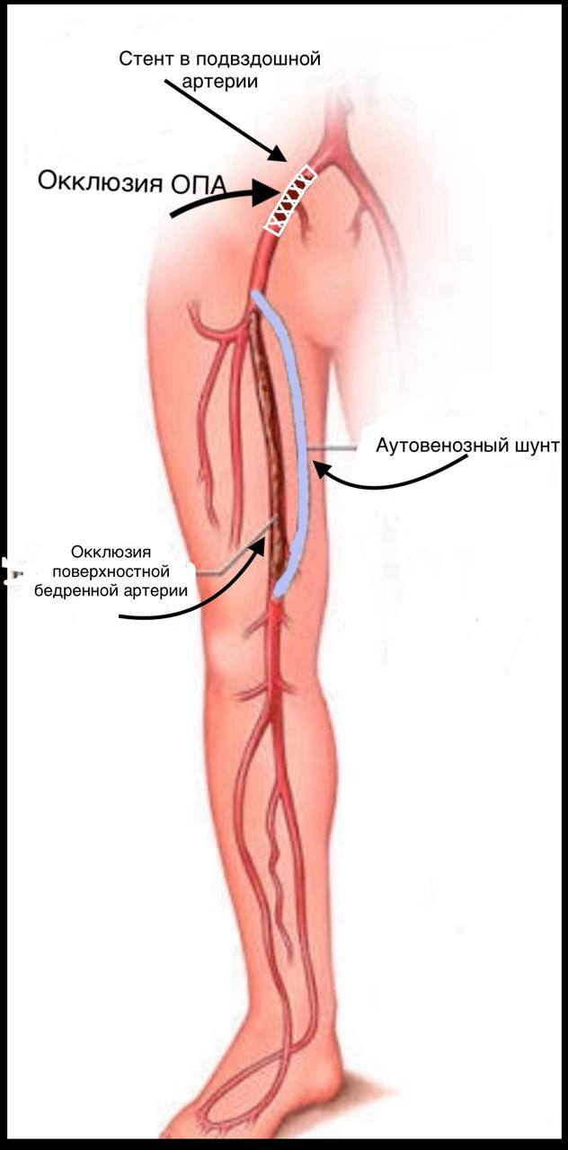 Дагестанцу спасли ногу, сделав уникальную гибридную операцию на артериях конечности Дагестанцу спасли ногу, сделав уникальную гибридную операцию на артериях конечности